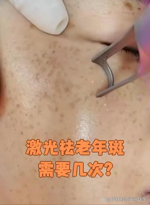 雀斑需要做几次激光