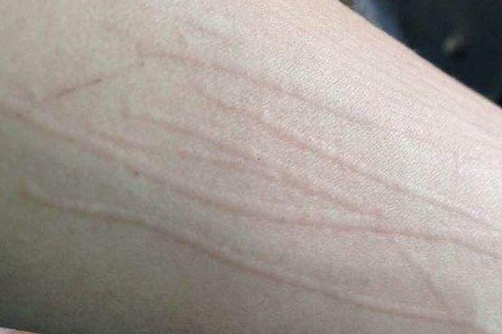 划痕皮肤