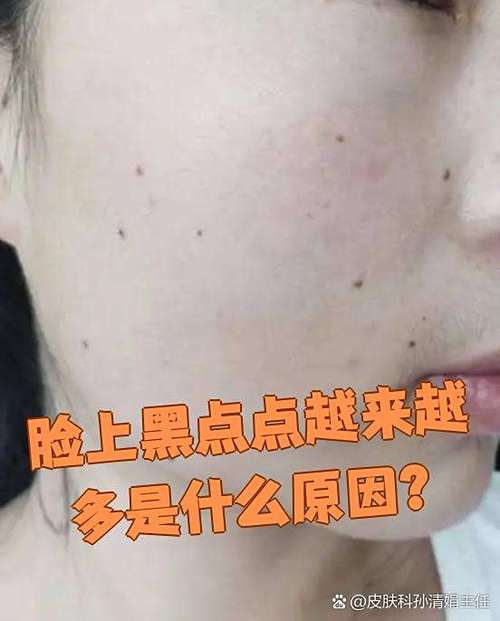 脸上小黑点会自己消失吗