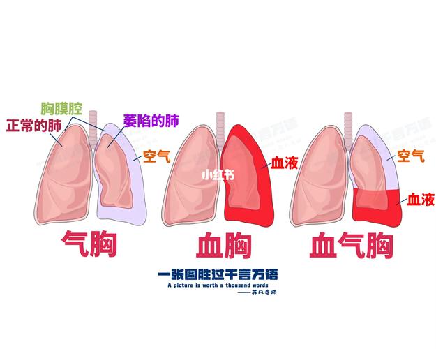 血胸和血气胸的区别