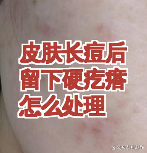 女孩说自己长痘痘了怎么恢复