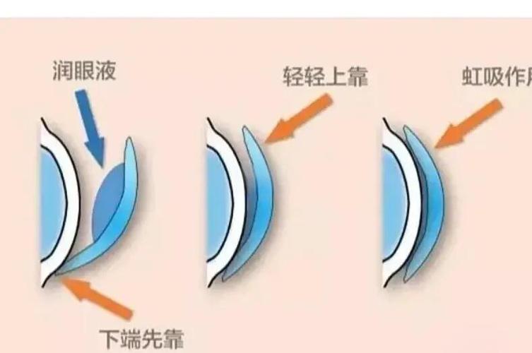 小孩戴ok镜到底好不好