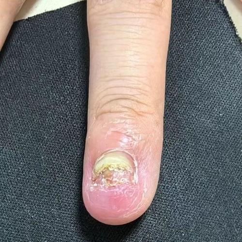 美甲整片脱落怎么补救