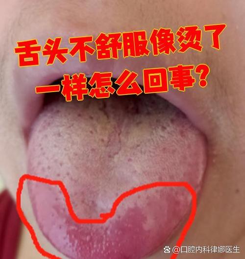 舌头不舒服像烫了一样截图