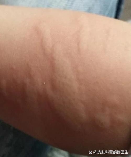 胳膊一挠起一片疙瘩是为什么
