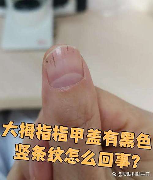 大拇指指甲盖有一条竖的黑线