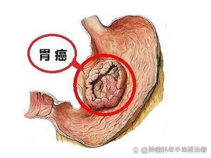 癌症转移和扩散一样吗