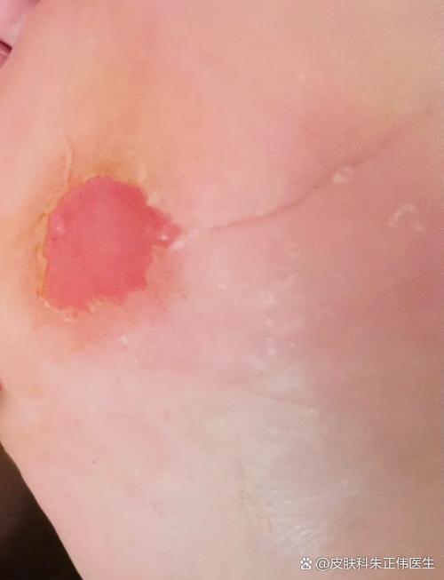 脚心痒能挠破皮吗