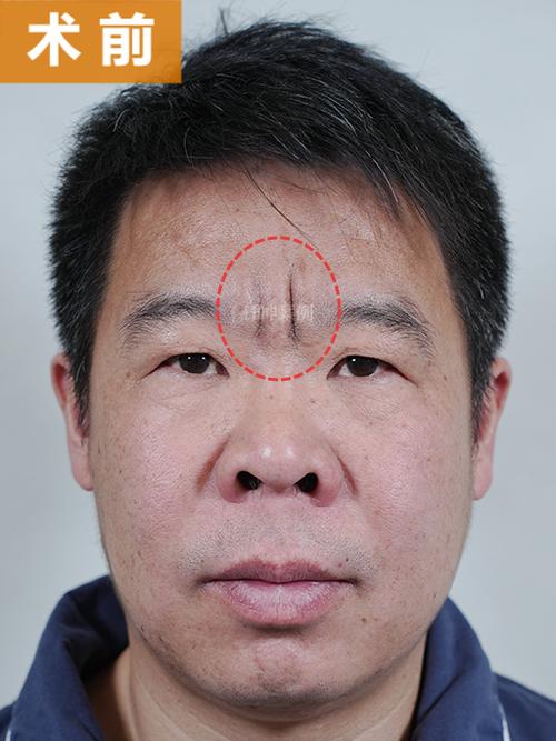 川字纹一旦缝了就不能去除吗