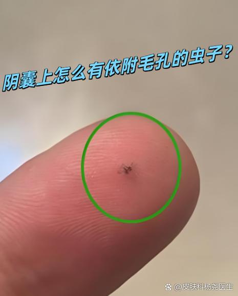 睾丸上有虫子那叫什么虫图片