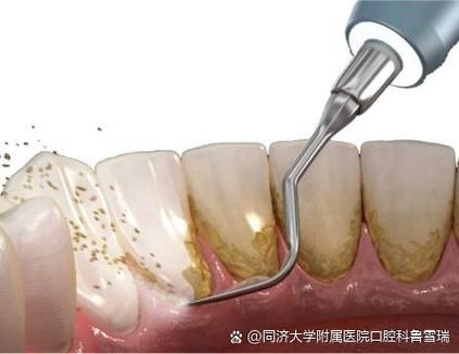 怎么让松动的牙齿脱落