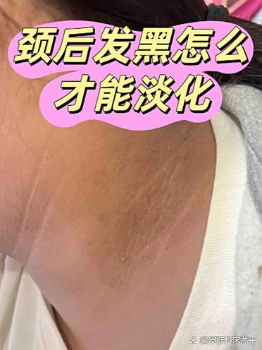 如何清除黑色素沉淀