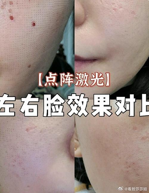 痘印有必要做激光吗