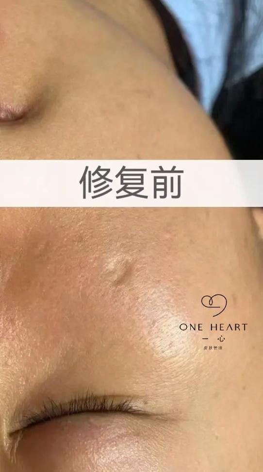 有痘印怎么办