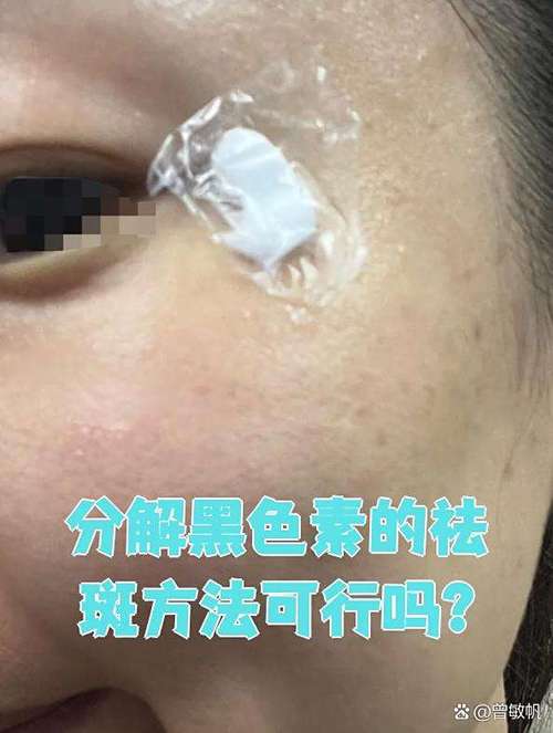 6s色素分解祛斑有效果吗