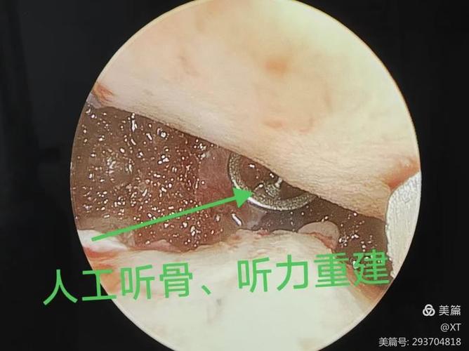 听力重建术后耳朵一动里面就有声音