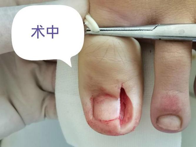 甲沟炎怎么治