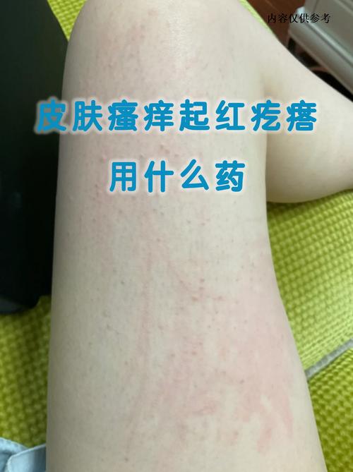 成都皮炎来寻军大举荐