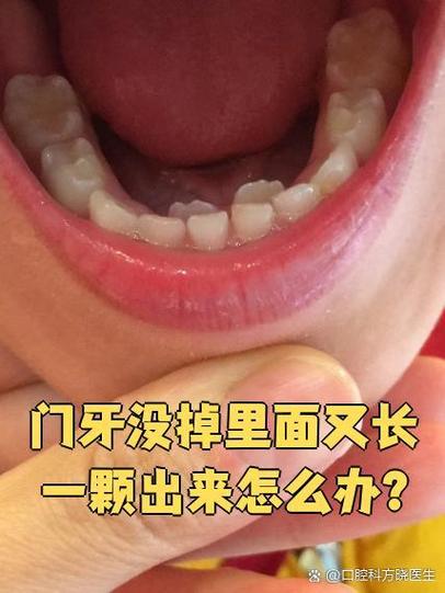 牙齿里面再长一颗牙齿怎么回事缩略图