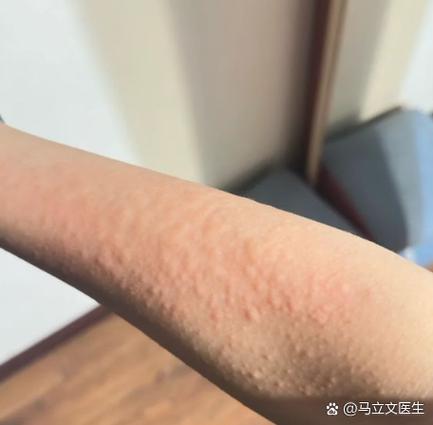 扑尔敏和香蕉敷脸对过敏有效吗?