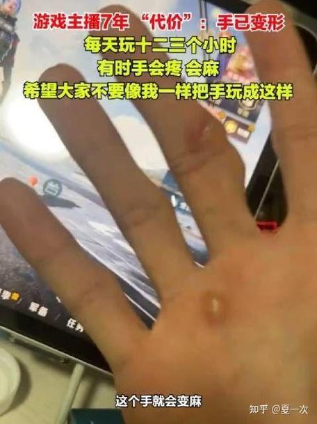 手指玩游戏变形了怎么办