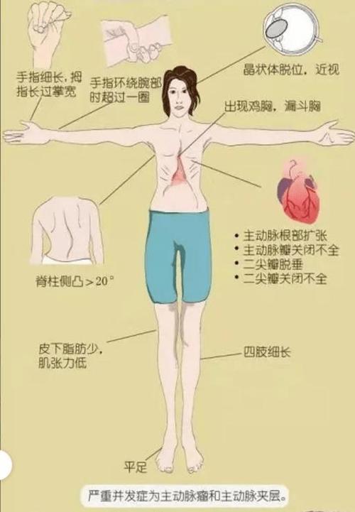 mfs医学上是什么意思