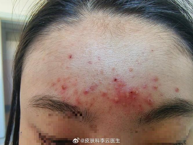 女生说长痘了怎么回