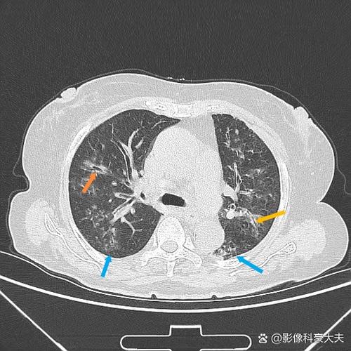 纤支管伤身体吗