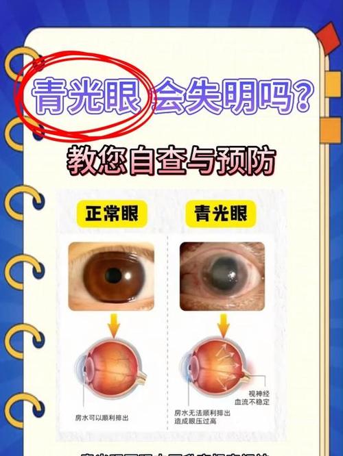 怎么判断自己是青光眼