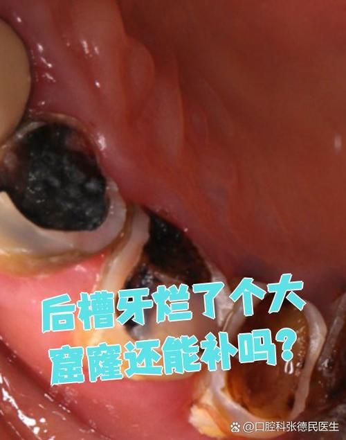 后面的一个大牙烂了个大洞怎么办