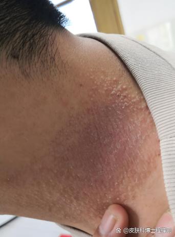 女人颈部有红斑要警惕截图