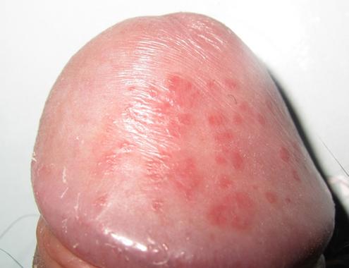 霉菌性炎症和男人有关吗