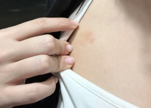 吻痕变淡了是什么颜色