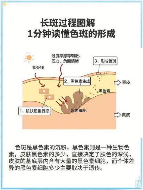 黄褐斑和晒斑的区别