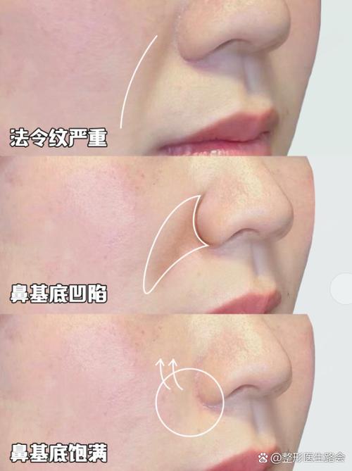 整鼻子最佳年龄