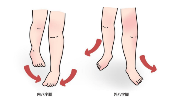 内八字脚走路的视频