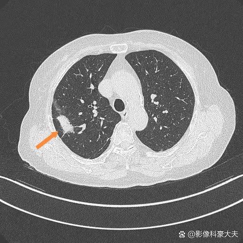 结节影是结节吗