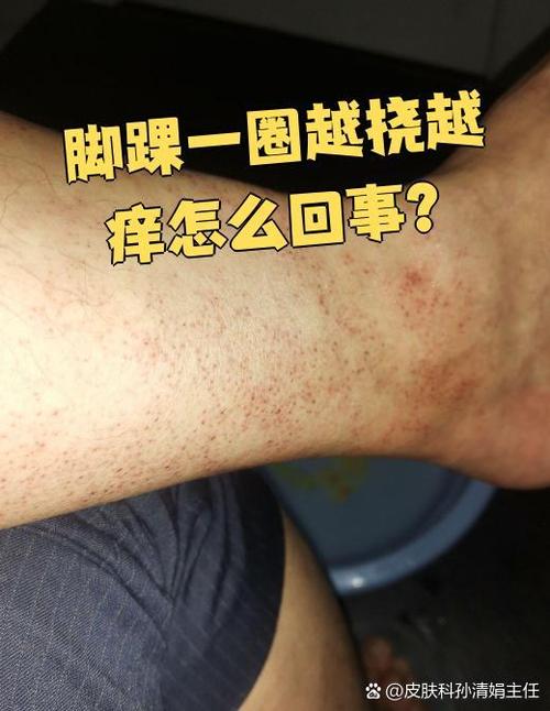 脚痒是什么原因截图