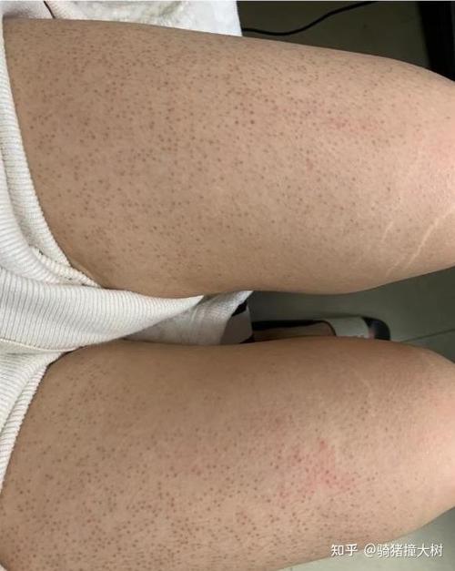 男人吃男人鸡要多久恢复