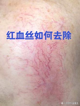 脸上毛血管红血丝如何去除