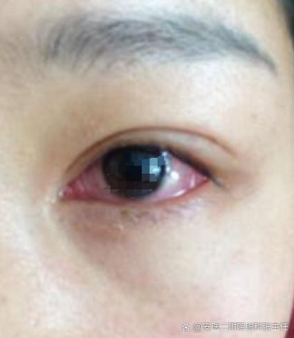 眼睛出现一层脏东西