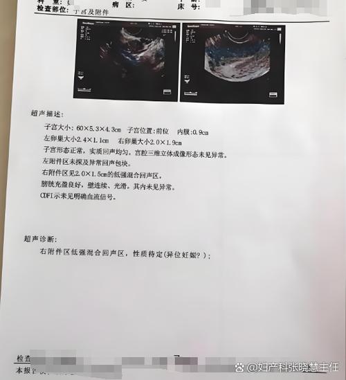 宫外孕打了甲氨蝶呤5天后hcg反升缩略图
