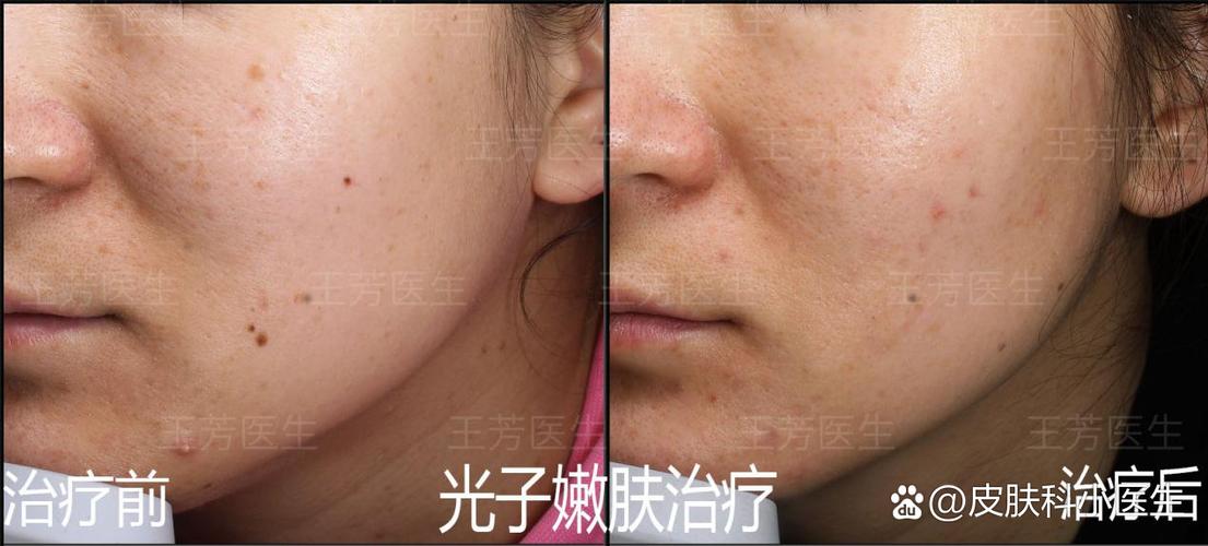 强脉冲光和激光的区别