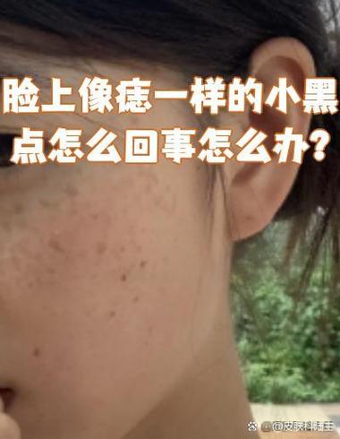 脸上像痣一样的小黑点怎么去除