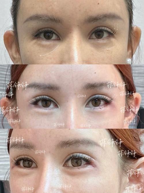 黑眼圈手术能去除吗