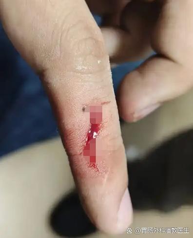 手指被刀削破了皮止不住血