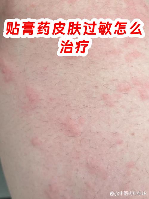 腿贴膏药过敏了痒怎么治疗