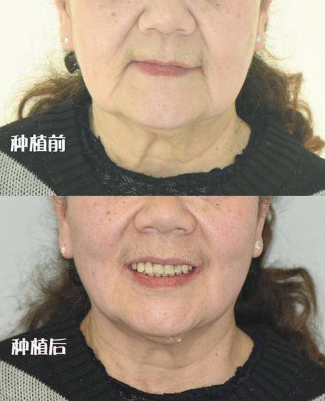 缺牙脸部凹陷图片截图
