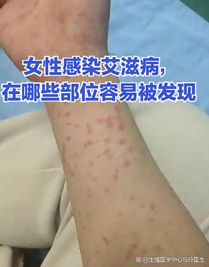 女性念珠菌阳性严重吗