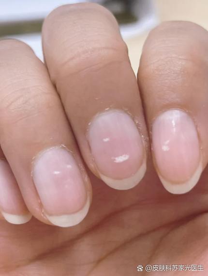 指甲白条纹